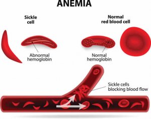 $117,500 Settlement for sickle cell crisis in Dallas, TX