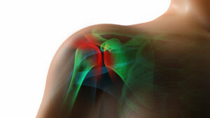 Rotator Cuff Injury Auto Accident in Dallas, TX Settles for $200,000