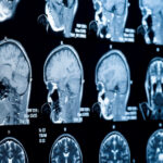 Traumatic Brain Injury Lawyers in Dallas, TX