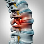 Herniated disc settlements