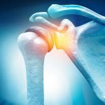 rotator cuff injuries